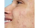 Erase Acne Scars for Good at Arna Clinic - Your Path to Clear Skin!