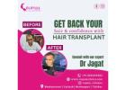 Top Hair Transplant Clinic in Bhubaneswar for Natural Results