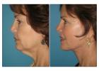 Neck lift surgery in Thane – Pristine Cosmesis