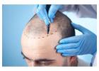 Hair Restoration in Chennai