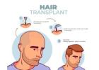 Hair Transplant in India: Affordable Cost, Expert Surgeon