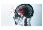 Brain aneurysm coiling Hospital in Saltlake