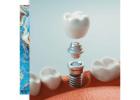 Restore Your Smile with Dental Implants in Columbia, SC