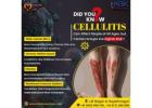 cellulitis treatment | KBK Multispeciality Hospitals