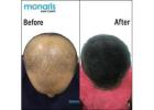 FUE Hair Transplant: Your Path to Natural Hair Transplant with Monaris Hair Clinic