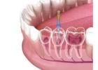 Looking for reliable root canal treatment in Calgary? 