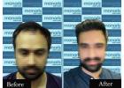 Discover the Best Hair Transplant Clinic in Delhi and Indore