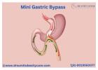 Best Laparoscopic Mini Gastric Bypass Treatment in Bangalore