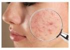 #1 Acne Scar Treatment in Hyderabad at Arna Clinic