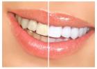 Teeth Whitening in Calgary | Brighten Your Smile with the Best Dental Care