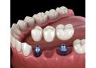 Affordable Dental Implants Cost in Euless, TX – Pleasant Dental