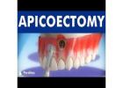 Best apicoectomy treatment in Dubai UAE