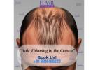 "Hair Thinning in the Crown? What You Can Do"