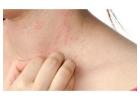 Best Urticaria treatment in Delhi at Skinology Clinic