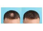 Best Hair Transplant in Bangalore