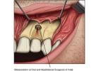 Best Endodontic surgery treatment in Dubai UAE