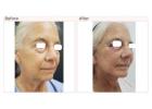 Everything You Need to Know About Mini Facelift Incisions