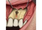 Best Periapical surgery treatment in Dubai UAE