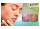 Effective and Deep Acne Scar Treatment in Bangalore - Dermaqure