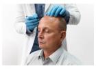 Hair Transplant PA – Natural Results, Expert Care at Feller Medical!