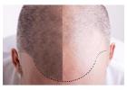 Best Hair Transplant