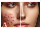 Best Acne Treatment in Delhi at DWC