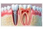 Best Dental Implant Clinic in Nagerbazar