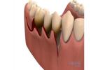 Best Periodontal surgery treatment in Dubai UAE