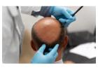 Hair Transplant in Greater Kailash, Delhi - Advanced Hair Treatment