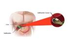 Expert Gallbladder Cancer Treatment in Ludhiana