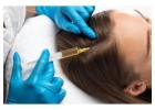 What Are the Benefits of PRP Treatment for Hair Loss?