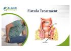 Reliable Fistula Treatment in Bangalore with Dr. Lohith U