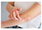 Say Goodbye to Itching: Homeopathy for Psoriasis.