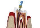 Best Root Canal Treatment in Kolkata at Teeth Care Multispecialty Dental Clinic