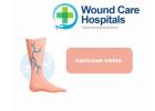 Varicose Veins Treatment in Hyderabad | Kukatpally | KPHB - WCH