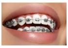 Get Perfectly Aligned Teeth with Braces at Teeth Care Multispecialty Dental Clinic