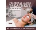 Advanced Fractional Laser Therapy for Acne Scars – Say Goodbye to Scars!