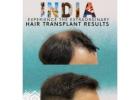 Restore Your Confidence with Advanced Hair Transplant