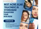 Best Acne Scar Treatment in Hyderabad – Transform Your Skin Now