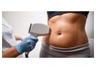 Advanced Laser Stretch Mark Removal London for Smooth Skin