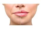 Best Service For Dermal Fillers in Hornchurch