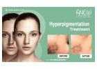 Transform Your Confidence – Hyperpigmentation Treatment at Anew