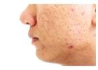 Acne Scar Treatment in Delhi - Transform Your Skin