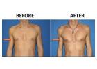 Male Chest Implants New York – Sculpt Your Ideal Chest