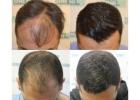 Find Best DHI Hair Transplant Cost for Full Restoration