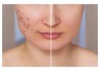 Best Treatment For Acne Scarring in Spitalfields