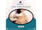 Laser Tattoo Removal - Winter Park Tattoo Removal