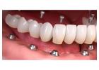 Same-Day Crowns  in Las Vegas at Functional Aesthetic Dentistry 