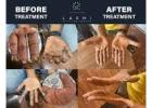  Effective & Best Vitiligo Treatment and Kits.