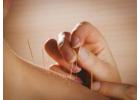 Top Fertility Acupuncture NYC